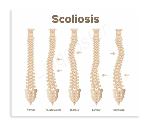 Human Spine Anatomy Chart Posture Guide Educational Canvas Wall-Art Poster for Physical Office Decor(Framed,12x18inch(30x45cm)) - color: Framed, size: 12x18inch(30x45cm)